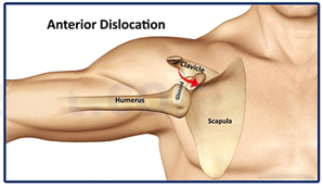 الخلع الأمامي للكتف