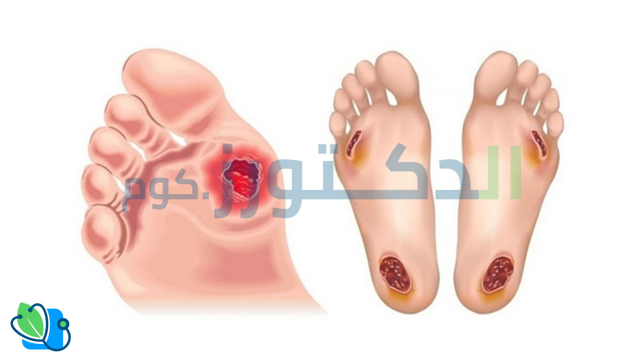 قرح القدم السكري و كيفية علاجها