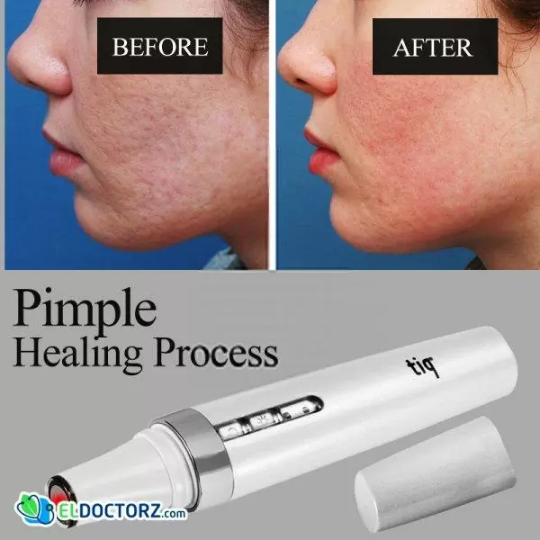 TIQ 24h Pimple Healing Process | AcneCare | جهاز تنظيف وتقشير البشرة