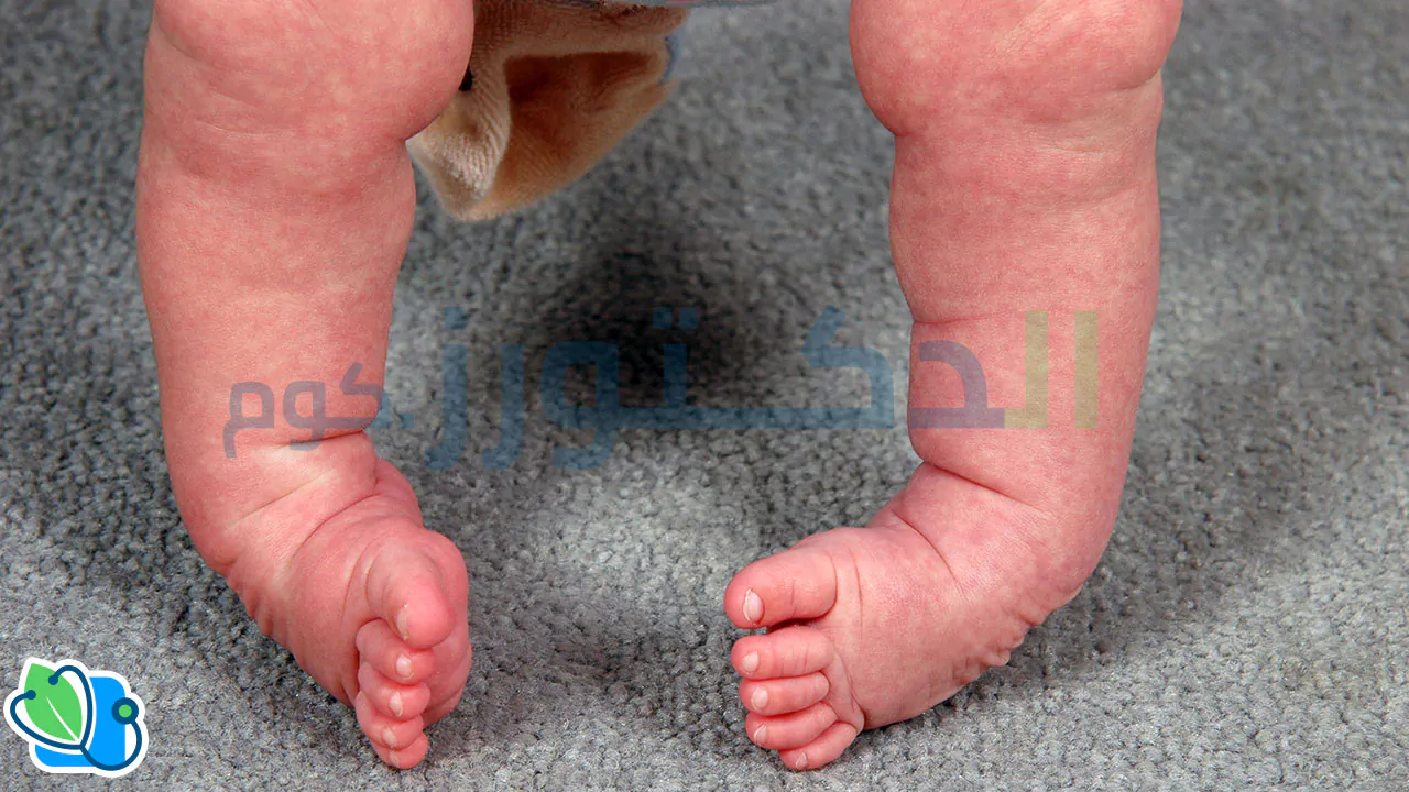 أسباب القدم المخلبية عند الاطفال وطرق علاجها